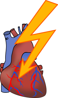 Heart attack