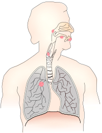 Cancer caused by smoking I