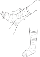 Leg Cast
