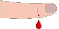 Bleeding finger