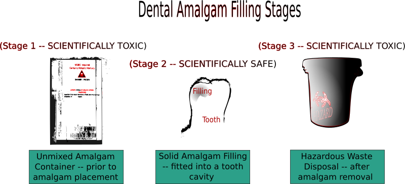 Dental Amalgam Filling Stages