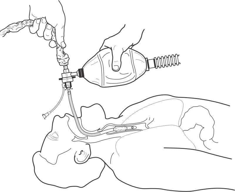 Endotracheal Procedure