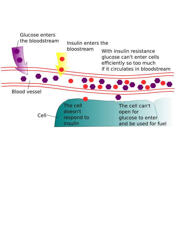 Diabetes and insulin resistance