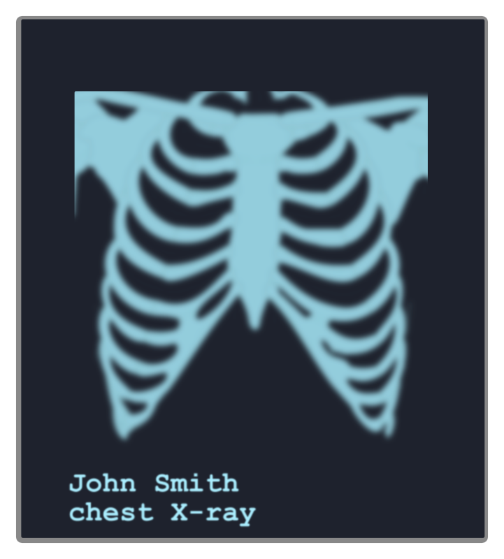 Chest X-ray image