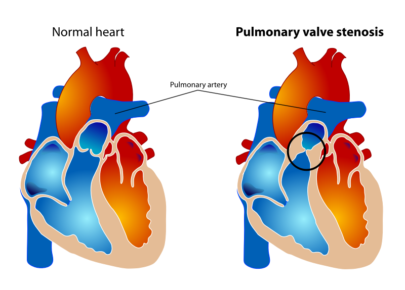 Pulmonary valve stenosis